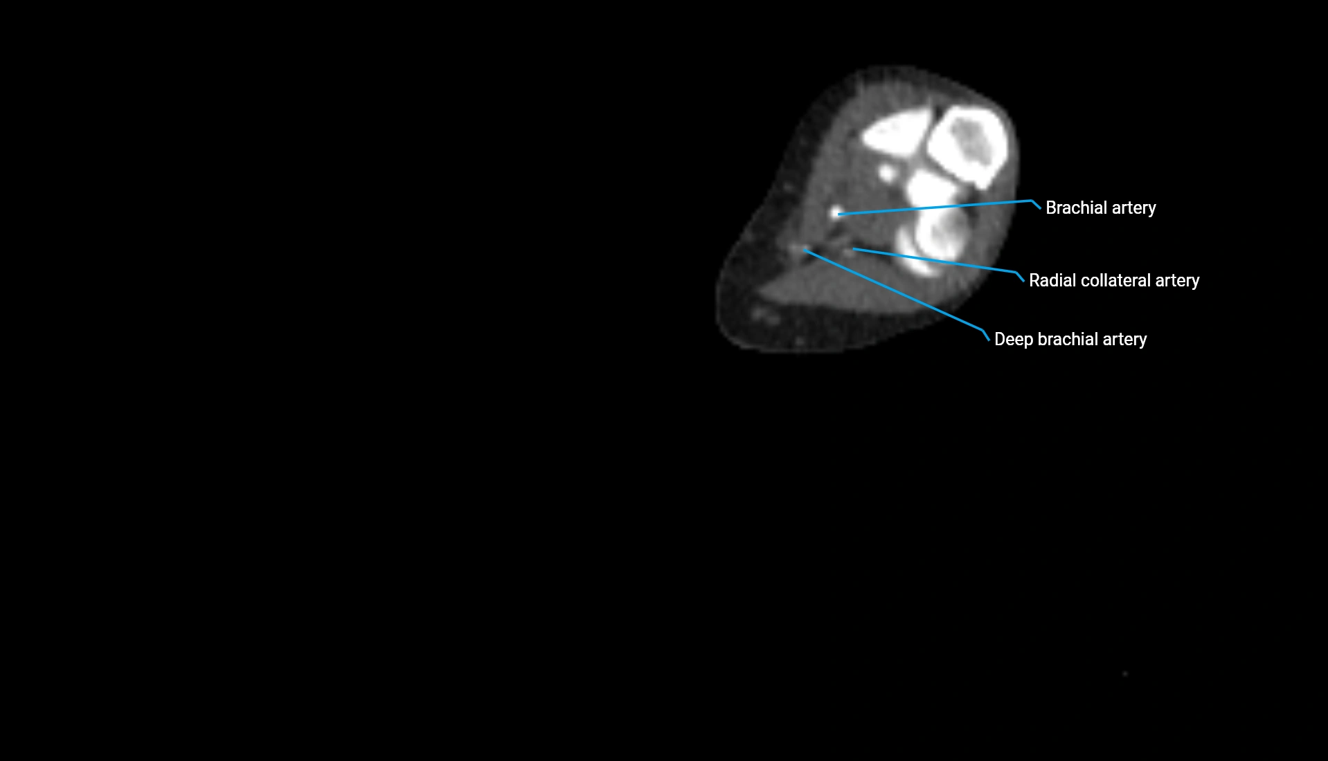 CTA upper limb axial cross sectional anatomy labelled image 185 (2).webp